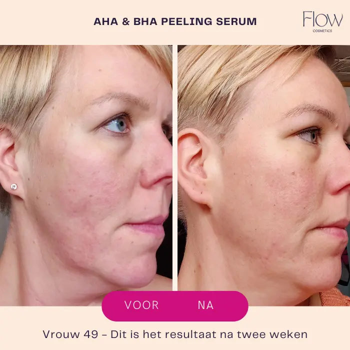 HA BHA peeling serum rijpere huid voor na gladder resultaat